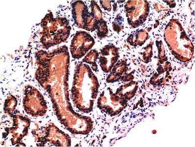 Fig.2. Immunohistochemical analysis of paraffin-embedded Human Prostate Tissue using Caspase-3 Mouse mAb diluted at 1:200.