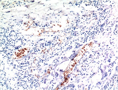 Fig.2. Immunohistochemical analysis of paraffin-embedded Human Breast Carcinoma Tissue using TGFβ1 Mouse mAb diluted at 1:200.