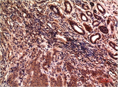 Fig.2. Immunohistochemical analysis of paraffin-embedded Human Breast Carcinoma Tissue using Gamma Tubulin Mouse mAb diluted at 1:200.