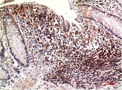 Fig.1. Immunohistochemical analysis of paraffin-embedded Human Colon Carcinoma Tissue using Epsilon Tubulin Mouse mAb diluted at 1:200.