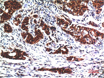 Fig.2. Immunohistochemical analysis of paraffin-embedded Human Breast Carcinoma Tissue using Akt Mouse mAb diluted at 1:200.