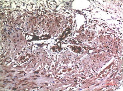 Fig.1. Immunohistochemical analysis of paraffin-embedded Human Colon Carcinoma Tissue using MMP2 Mouse mAb diluted at 1:200.