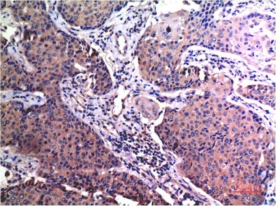 Fig.2. Immunohistochemical analysis of paraffin-embedded Human Breast Carcinoma Tissue using MMP2 Mouse mAb diluted at 1:200.