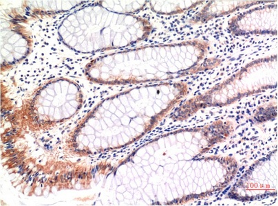 Fig.1. Immunohistochemical analysis of paraffin-embedded Human Colon Carcinoma Tissue using Phospho-MLKL S358 Mouse mAb diluted at 1:200.