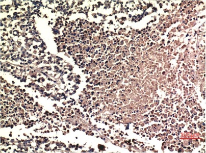 Fig.1. Immunohistochemical analysis of paraffin-embedded Human Lung Carcinoma Tissue using ERK1/2 Mouse mAb diluted at 1:200.