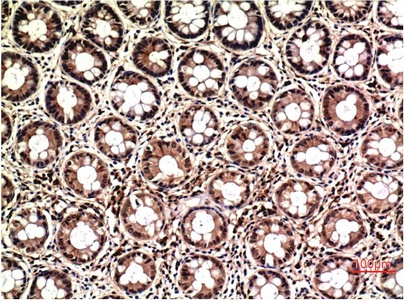 Fig.2. Immunohistochemical analysis of paraffin-embedded Human Colon Carcinoma Tissue using ERK1/2 Mouse mAb diluted at 1:200.