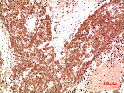 Fig.1. Immunohistochemical analysis of paraffin-embedded Human Lung Carcinoma Tissue using AMPk a1 Mouse mAb diluted at 1:200.