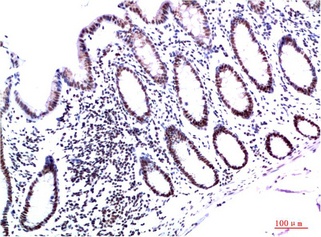 Fig.1. Immunohistochemical analysis of paraffin-embedded Human Colon Carcinoma Tissue using HP-1γ Mouse mAb diluted at 1:200.