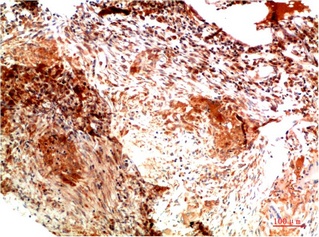 Fig. Immunohistochemical analysis of paraffin-embedded Human Lung Carcinoma Tissue using Collagen II Mouse mAb diluted at 1:200.