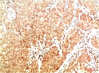Fig.1. Immunohistochemical analysis of paraffin-embedded Human Breast Carcinoma Tissue using Acetyl NF kB P65 (K314/K315) Mouse mAb diluted at 1:200.