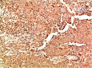 Fig.2. Immunohistochemical analysis of paraffin-embedded Human Lung Carcinoma Tissue using Acetyl NF kB P65 (K314/K315) Mouse mAb diluted at 1:200.