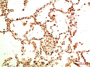 Fig.2. Immunohistochemical analysis of paraffin-embedded Human Lung Carcinoma Tissue using Acetyl NF kB P65 (K314/K315) Mouse mAb diluted at 1:200.