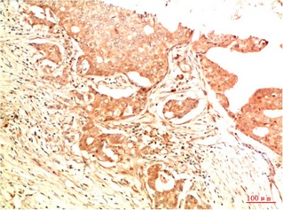 Fig.1. Immunohistochemical analysis of paraffin-embedded Human Breast Carcinoma Tissue using Acetyl P53 (K382) Mouse mAb diluted at 1:200.