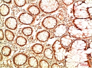 Fig.2. Immunohistochemical analysis of paraffin-embedded Human Colon Carcinoma Tissue using Acetyl P53 (K382) Mouse mAb diluted at 1:200.