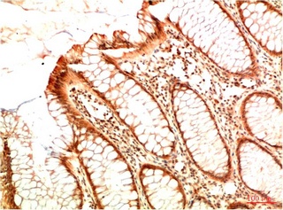 Fig.3. Immunohistochemical analysis of paraffin-embedded Human Colon Carcinoma Tissue using Acetyl P53 (K382) Mouse mAb diluted at 1:200.
