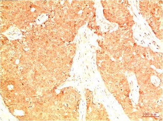 Fig.1. Immunohistochemical analysis of paraffin-embedded Human Breast Carcinoma Tissue using Acetyl P53 (K382) Mouse mAb diluted at 1:200.