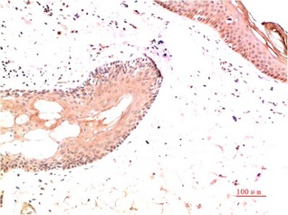 Fig.2. Immunohistochemical analysis of paraffin-embedded Human Skin Carcinoma Tissue using Collagen I Mouse mAb diluted at 1:200.