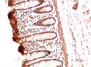 Fig.2. Immunohistochemical analysis of paraffin-embedded Human Colon Carcinoma Tissue using Collagen II Mouse mAb diluted at 1:500.