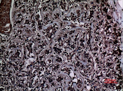 Fig.3. Immunohistochemical analysis of paraffin-embedded human-breast, antibody was diluted at 1:100.