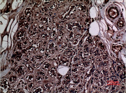 Fig.3. Immunohistochemical analysis of paraffin-embedded human-breast, antibody was diluted at 1:100.