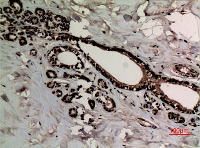 Fig.3. Immunohistochemical analysis of paraffin-embedded human-breast-cancer, antibody was diluted at 1:100.