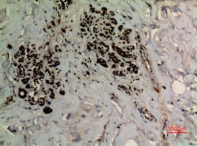 Fig.3. Immunohistochemical analysis of paraffin-embedded human-breast, antibody was diluted at 1:100.