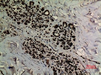 Fig.4. Immunohistochemical analysis of paraffin-embedded human-breast, antibody was diluted at 1:100.