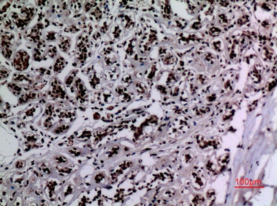 Fig.3. Immunohistochemical analysis of paraffin-embedded human-breast, antibody was diluted at 1:100.