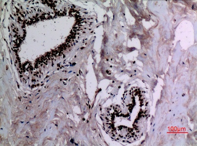 Fig.4. Immunohistochemical analysis of paraffin-embedded human-breast, antibody was diluted at 1:100.