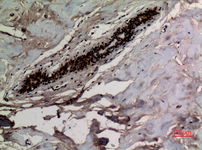 Fig.3. Immunohistochemical analysis of paraffin-embedded human-breast, antibody was diluted at 1:100.