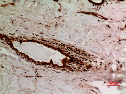 Fig.2. Immunohistochemical analysis of paraffin-embedded human-breast, antibody was diluted at 1:100.