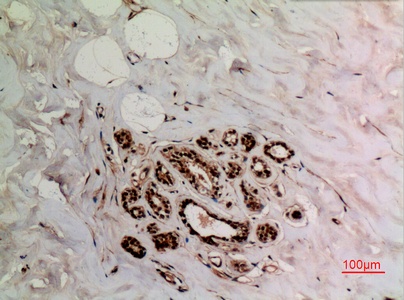 Fig.3. Immunohistochemical analysis of paraffin-embedded human-breast, antibody was diluted at 1:100.