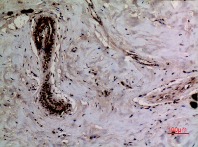 Fig.4. Immunohistochemical analysis of paraffin-embedded human-breast, antibody was diluted at 1:100.