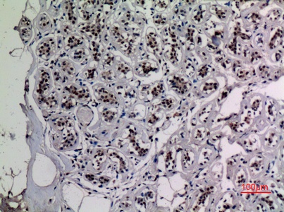 Fig.3. Immunohistochemical analysis of paraffin-embedded human-breast, antibody was diluted at 1:100.