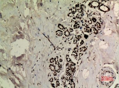 Fig.3. Immunohistochemical analysis of paraffin-embedded human-breast, antibody was diluted at 1:100.