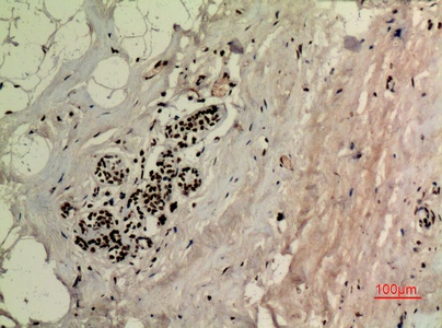 Fig.4. Immunohistochemical analysis of paraffin-embedded human-breast, antibody was diluted at 1:100.
