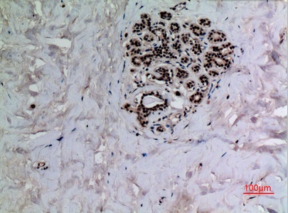Fig.3. Immunohistochemical analysis of paraffin-embedded human-breast, antibody was diluted at 1:100.