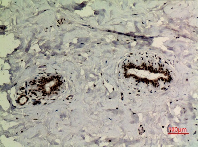 Fig.3. Immunohistochemical analysis of paraffin-embedded human-breast, antibody was diluted at 1:100.