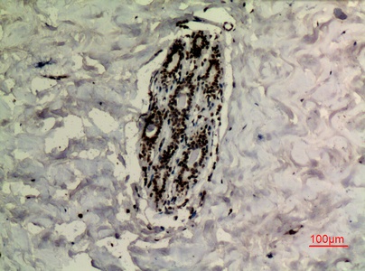Fig.4. Immunohistochemical analysis of paraffin-embedded human-breast, antibody was diluted at 1:100.