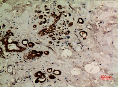 Fig.3. Immunohistochemical analysis of paraffin-embedded human-breast, antibody was diluted at 1:100.