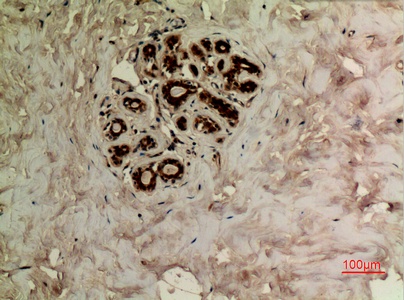 Fig.4. Immunohistochemical analysis of paraffin-embedded human-breast, antibody was diluted at 1:100.