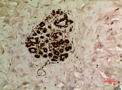 Fig.3. Immunohistochemical analysis of paraffin-embedded human-breast, antibody was diluted at 1:100.