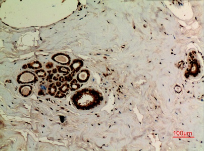Fig.4. Immunohistochemical analysis of paraffin-embedded human-breast, antibody was diluted at 1:100.