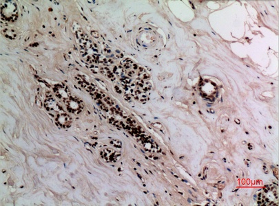 Fig.3. Immunohistochemical analysis of paraffin-embedded human-breast, antibody was diluted at 1:100.