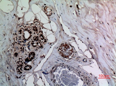 Fig.4. Immunohistochemical analysis of paraffin-embedded human-breast, antibody was diluted at 1:100.