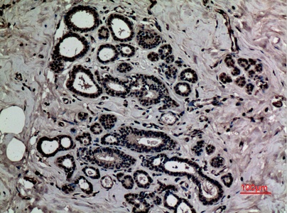 Fig.2. Immunohistochemical analysis of paraffin-embedded human-breast, antibody was diluted at 1:100.