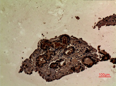Fig.2. Immunohistochemical analysis of paraffin-embedded human-prostate-cancer, antibody was diluted at 1:100.