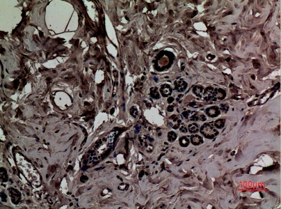 Fig.2. Immunohistochemical analysis of paraffin-embedded human-breast, antibody was diluted at 1:100.