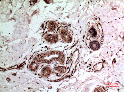 Fig.2. Immunohistochemical analysis of paraffin-embedded human-breast-cancer, antibody was diluted at 1:100.