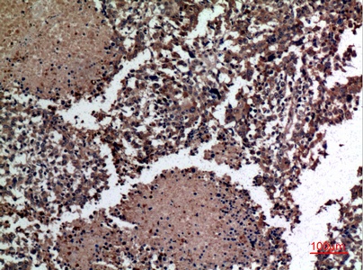 Fig.2. Immunohistochemical analysis of paraffin-embedded human-lung-cancer, antibody was diluted at 1:100.